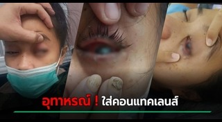 คอนแทคเลนส์