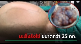 มะเร็งรังไข่