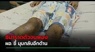 แผลพุพอง