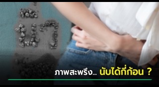 นิ่วในถุงน้ำดี