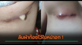 เสริมหน้าอก