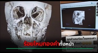 ร้อยไหม