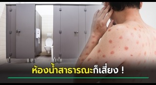 ฝีดาษลิง