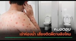 ฝีดาษลิง