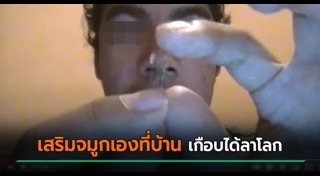 ศัลยกรรมจมูก