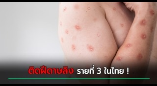 ฝีดาษลิง