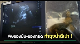 นิ่วในถุงน้ำดี