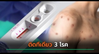 ฝีดาษลิง