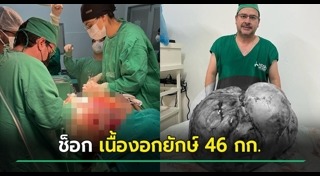 เนื้องอก