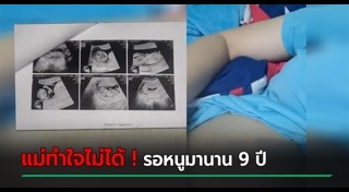 ดาวน์ซินโดรม