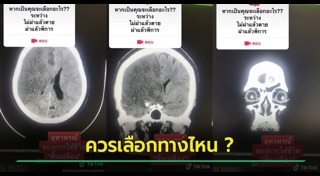ผ่าตัดสมอง