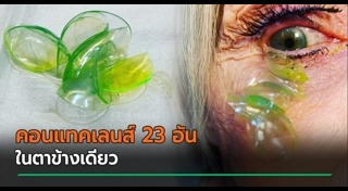 คอนแทคเลนส์