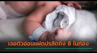 แฝดปรสิต