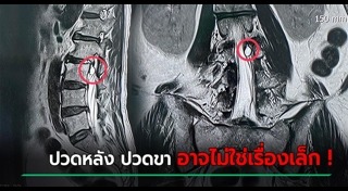 ปวดหลัง