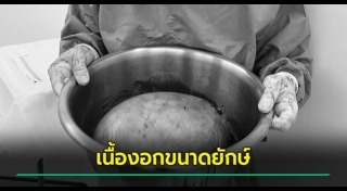 เนื้องอก