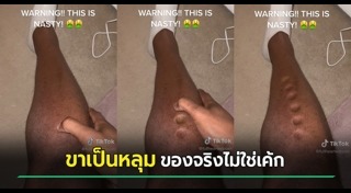 ผิวหนังอักเสบ