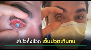 คอนแทคเลนส์