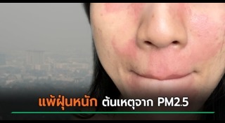 ลมพิษ