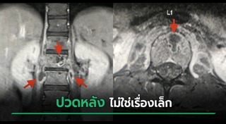 ปวดหลัง