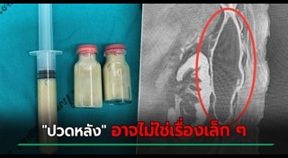 ปวดหลัง