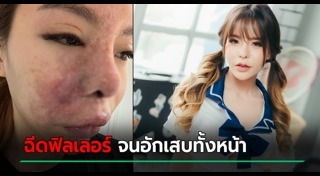 ฉีดโบท็อกซ์