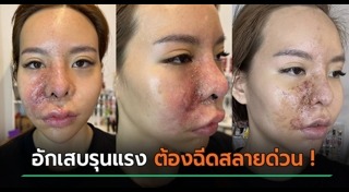 ฉีดฟิลเลอร์