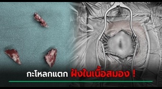 ผ่าตัดสมอง