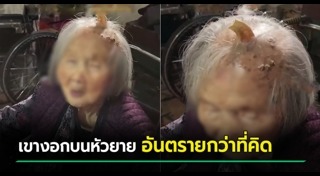 เนื้องอก