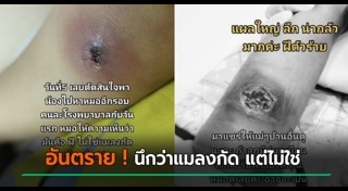 ผิวหนังอักเสบ