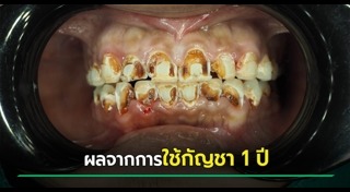 ฟันผุ