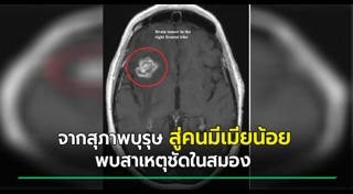เนื้องอก