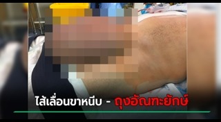 ไส้เลื่อน