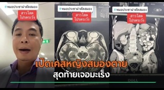 มะเร็งรังไข่