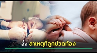 แฝดปรสิต