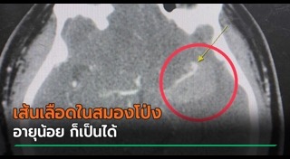 ผ่าตัดสมอง