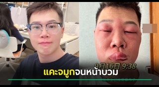 หน้าบวม