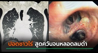 ปอดติดเชื้อ