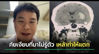 เส้นเลือดสมองแตก