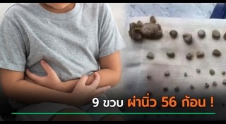 นิ่วในไต