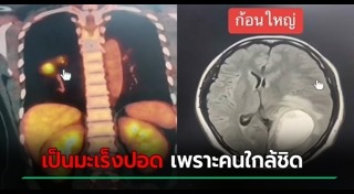 มะเร็งปอด