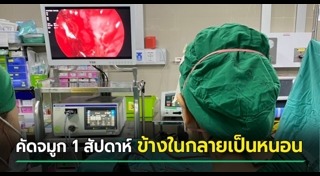 หนอนในหู