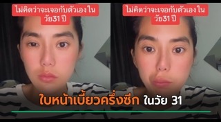โรคหน้าเบี้ยวครึ่งซีก