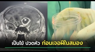 ไซนัสอักเสบ