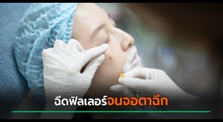 ฉีดฟิลเลอร์