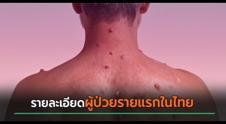 ฝีดาษลิง