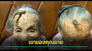 เนื้องอก