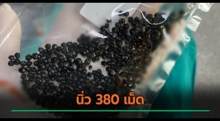 นิ่วในถุงน้ำดี