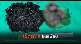 นิ่วในถุงน้ำดี