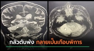 ไตวายเฉียบพลัน