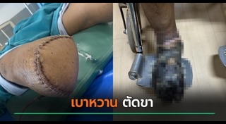 โรคเบาหวาน